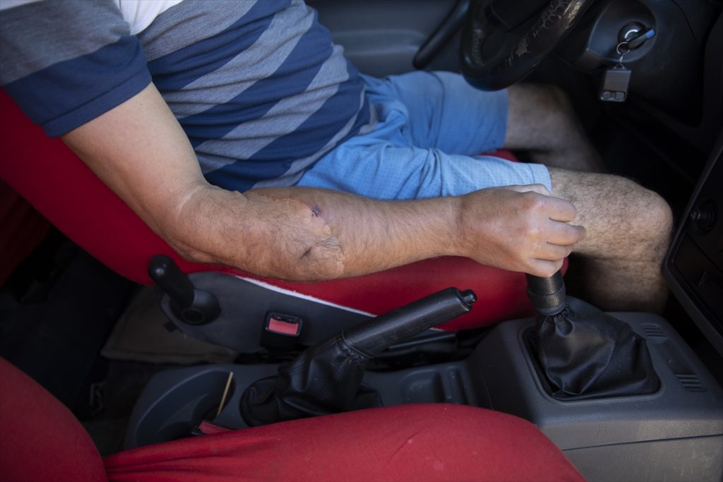 20200819 2 43952835 57511783 Web Türkiye'nin ilk çift kol nakilli hastası Cihan Topal kollarına gözü gibi bakıyor